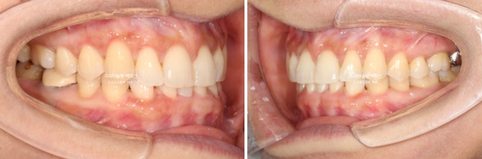 해외거주 앞니 선천적 결손 과개교합 인비절라인 라이트 브릿지 치료 관련 이미지 14