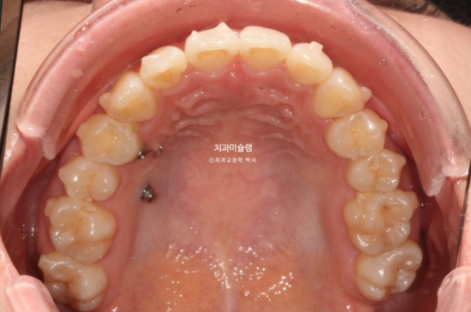 인비절라인 비발치 토끼이빨 교정 덧니 교정 치료기간 1년 8개월 관련 이미지 8