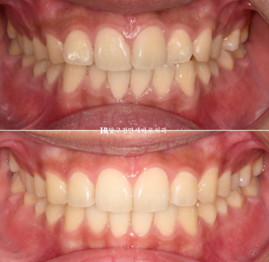 인비절라인 라이트 교정 덧니 이소맹출 반대교합 관련 이미지 1