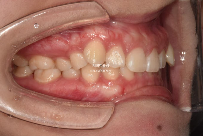 잇몸미소 거미스마일 치료 옥니 교정 잇몸성형 후기 관련 이미지 5