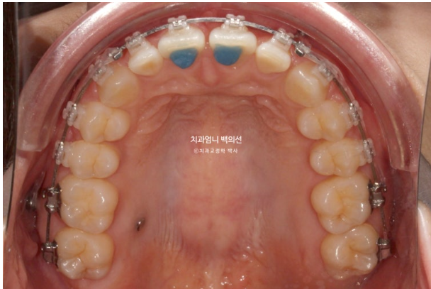 거미스마일 과개교합 교정 잇몸돌출 잇몸 비대칭 관련 이미지 7