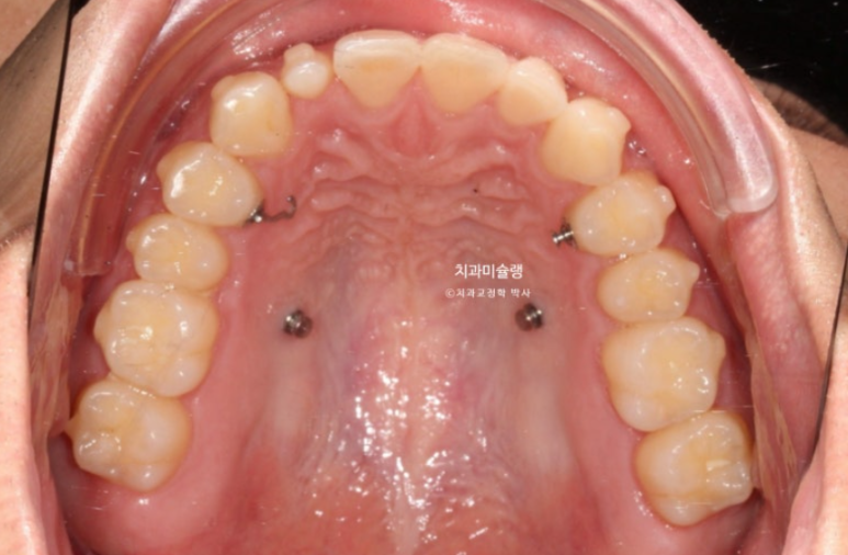 옥니 덧니 교정 왜소치 선천적 결손 3전치 무삭제 라미네이트 인비절라인 교정 관련 이미지 11