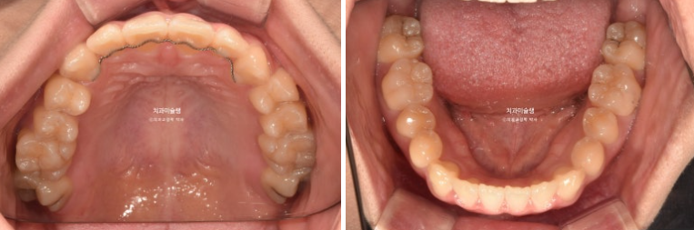 비발치 비수술 주걱턱 반대교합 재교정 치료 관련 이미지 5