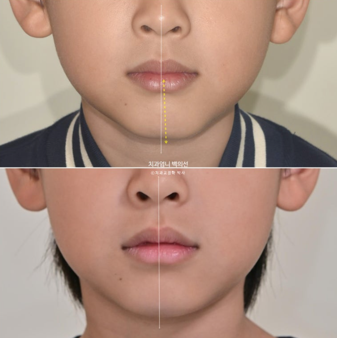 어린이 교정 인비절라인 퍼스트 비대칭 반대교합 어린이 성장 교정 관련 이미지 22