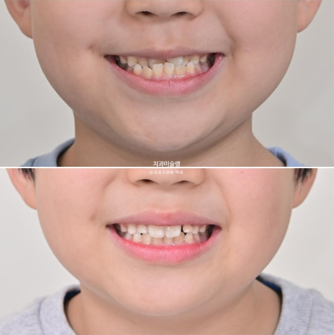 7세 어린이 반대교합 부정교합 프리올소 치료 관련 이미지 12