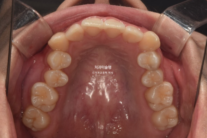잇몸미소 거미스마일 치료 옥니 교정 잇몸성형 후기 관련 이미지 6
