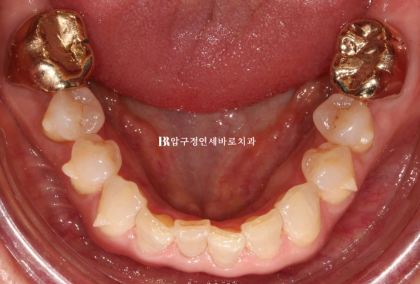 50s Invisalign Lite No-Prep Laminate Bunny Teeth image 8