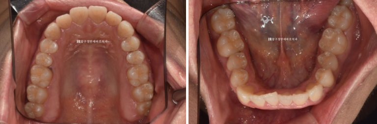 인비절라인 라이트 과개교합 반대교합 돌출입 뻐드렁니 교정 치료 관련 이미지 4