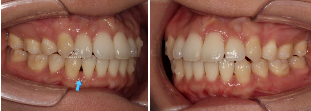 30대 돌출입 덧니 교정 인비절라인 발치교정 후기 관련 이미지 10