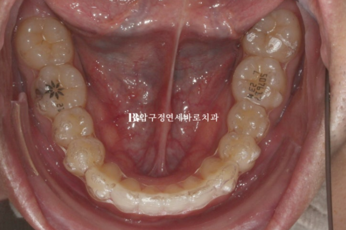 인비절라인 재제작 없이 끝낸 벌어진 치아 교정 케이스 관련 이미지 3