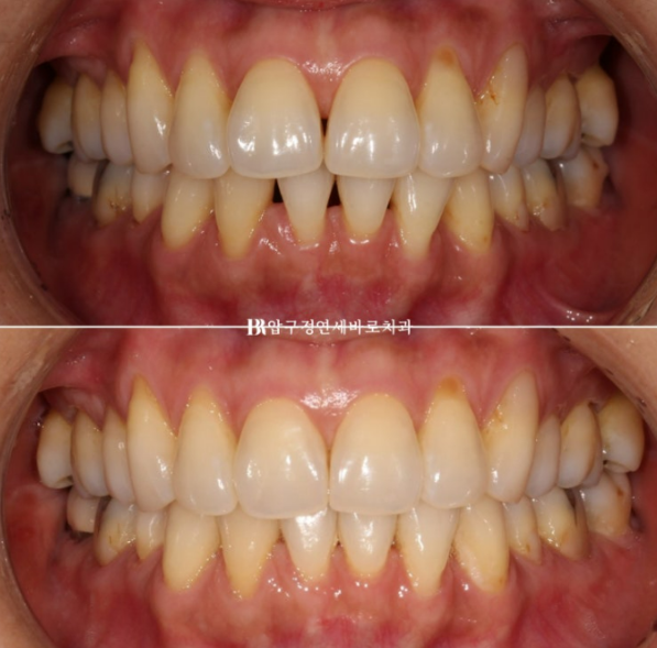 블랙트라이앵글 없애는 교정 가능할까요? 재교정 단기교정 후기 관련 이미지 1