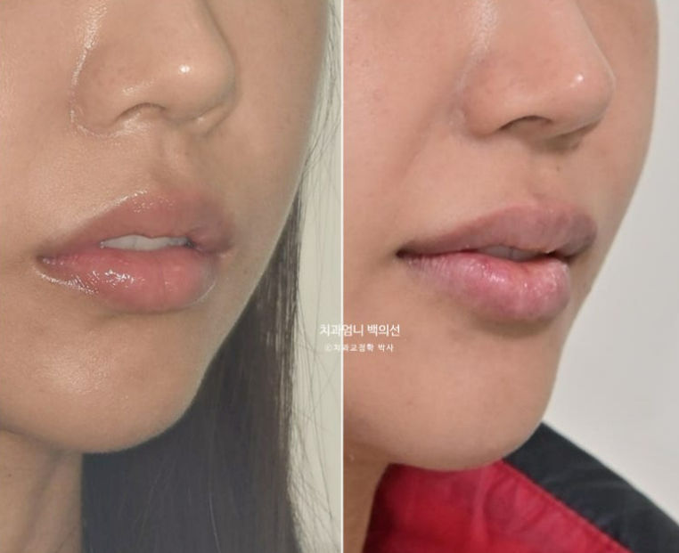 인비절라인 비발치 덧니 교정 반대교합 치료 후기 관련 이미지 21