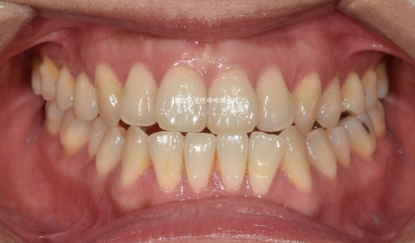 양악수술 선수술 교정 후기 인비절라인 교정 관련 이미지 1