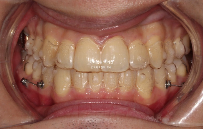 인비절라인 비발치 앞니 돌출 덧니 교정 ? 관련 이미지 6