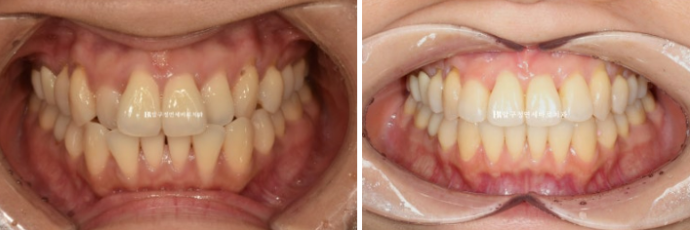 토끼이빨도 부분교정이 가능할까요? 30대 앞니 반대교합 6개월 치료 사례 관련 이미지 6