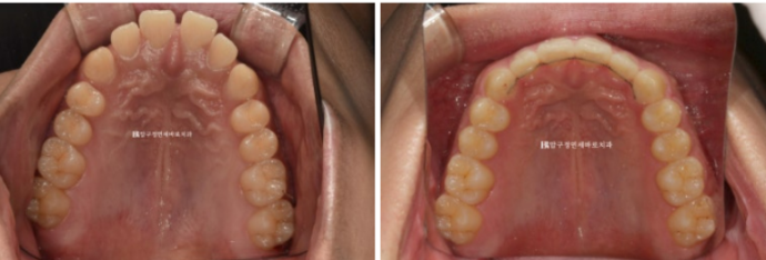 Can Invisalign Fix a Gap Between the Front Teeth? ๐ฎ A Real 9-Month Case Finished Without Remaking Aligners image 8
