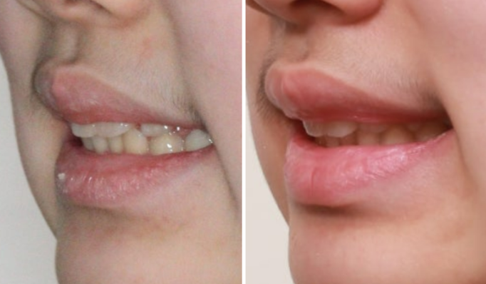 덧니 인비절라인 교정 :: 강남 인비절라인 교정치과 관련 이미지 8