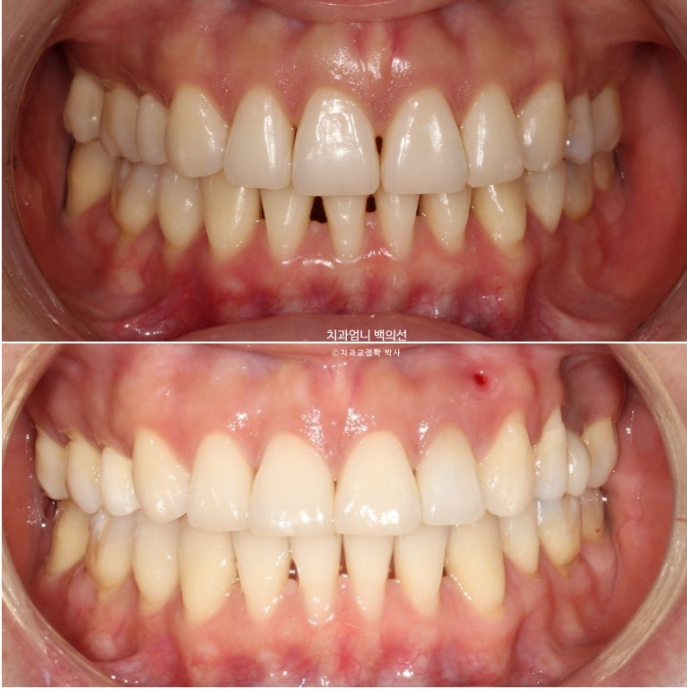 옥니 역교정 재교정 무턱 교정 치료기간 1년 10개월 관련 이미지 17