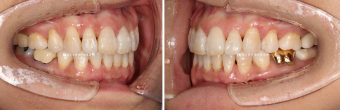 50대 치아교정 인비절라인 라이트 앞니교정 치료 후기 관련 이미지 10