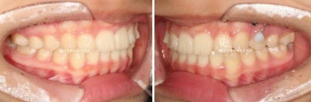 어린이 투명교정 인비절라인 틴 덧니 교정 후기 관련 이미지 10