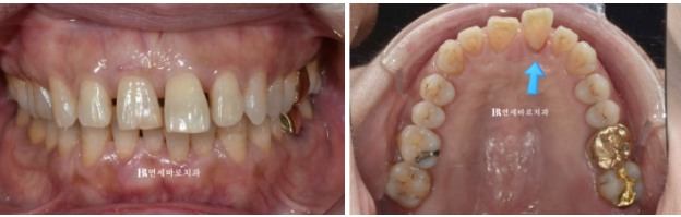 50대 60대 중년 치아 벌어짐 단기 교정 해결하기 관련 이미지 2