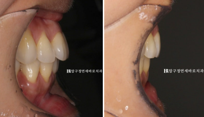 How Can Black Triangles Be Removed? Is Re-treatment Orthodontics an Option? image 8