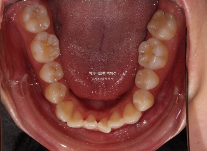 비수술 주걱턱 비대칭 발치 교정 결손치 반대교합 클리피씨 치료기간 1년 11개월 관련 이미지 6