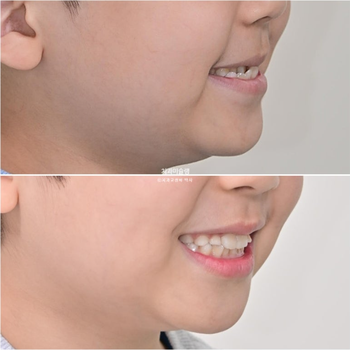 7세 어린이 반대교합 부정교합 프리올소 치료 관련 이미지 13