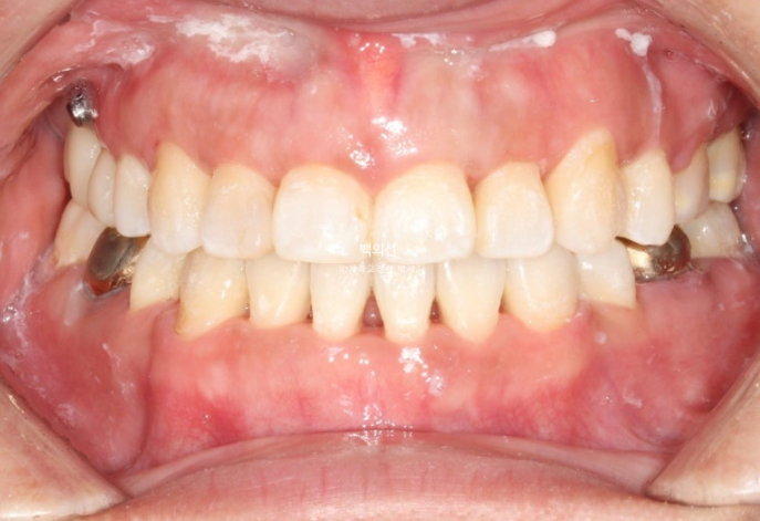 거미스마일 교정 돌출입 발치교정 입술부전 호두턱 치료기간 2년반 관련 이미지 14