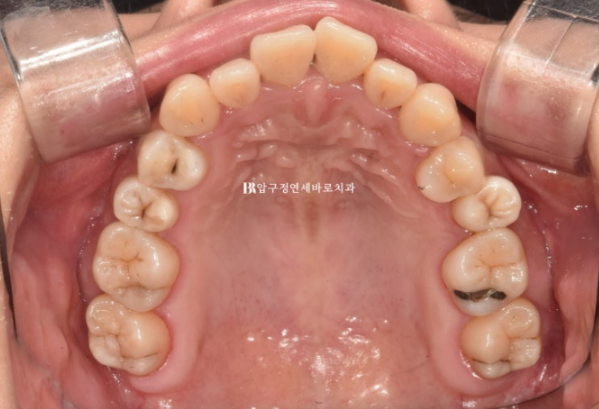 Invisalign Success Depends on Wearing Them Consistently|9-Month Real Treatment Case of Crowding & Underbite image 4