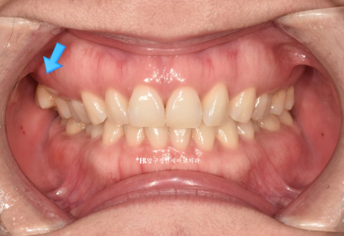 인비절라인 라이트 가위교합 벌어짐 중심선 미니스크류 치료기간 11개월 관련 이미지 2