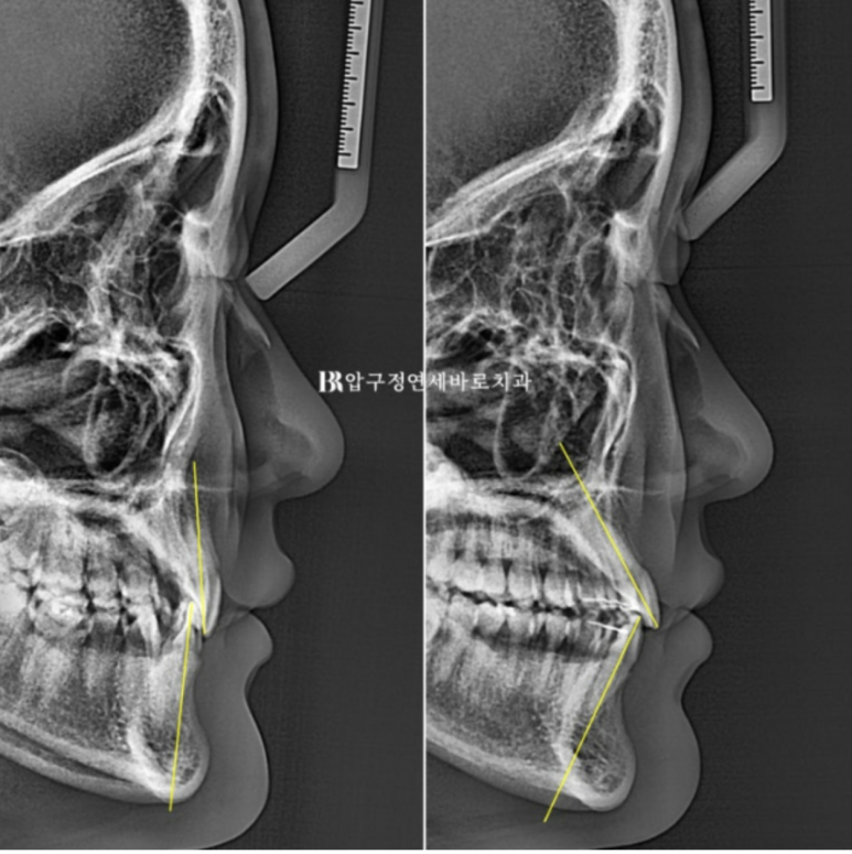 옥니교정 / 웃을때 아랫니만 보여요. 앞니 노출도 교정? 관련 이미지 12
