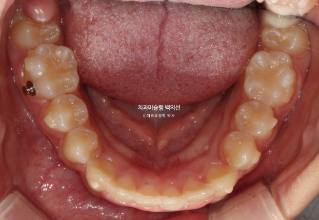 과개교합 인비절라인 모더레이트 컴프레헨시브 중심선 토끼이빨 관련 이미지 10
