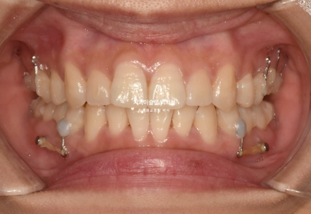 인비절라인 돌출입 발치교정 임플란트 없이 사랑니 대체 관련 이미지 10