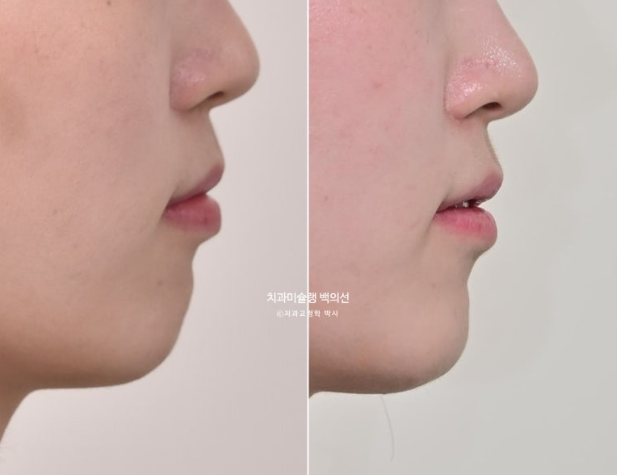 잇몸미소 인비절라인 거미스마일 토끼이빨 교정 무삭제 라미네이트 반대교합 치료 후기 관련 이미지 22