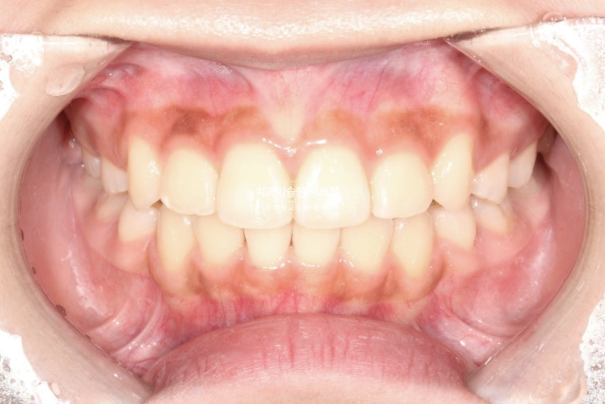 돌출입 무턱 인비절라인 발치교정 덧니 치료기간 1년 11개월 관련 이미지 10