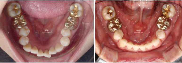 거미스마일 교정 돌출입 발치교정 입술부전 호두턱 치료기간 2년반 관련 이미지 19