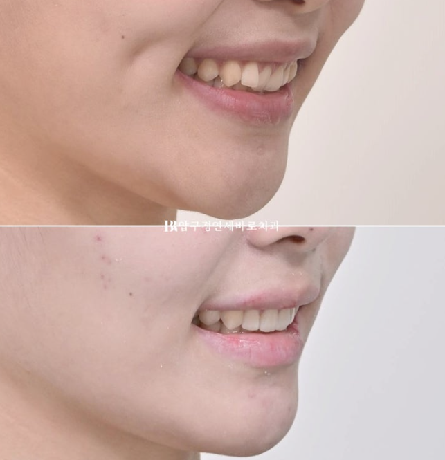 압구정 교정치과 / 옥니교정 인비절라인 라이트 덧니교정 관련 이미지 1