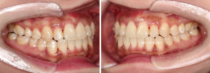 Is compliance important for Invisalign? | A real case that improved reverse bite and scissors bite in 8 months image 8