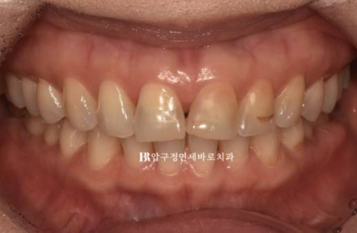 Laminate Veneers in Your 50s: Is It Possible Without Shaving Down the Teeth? | No-Prep Laminate Veneers + Real Case of Front Tooth Partial Orthodontics image 2