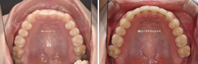 압구정 교정치과 / 옥니교정 인비절라인 라이트 덧니교정 관련 이미지 13