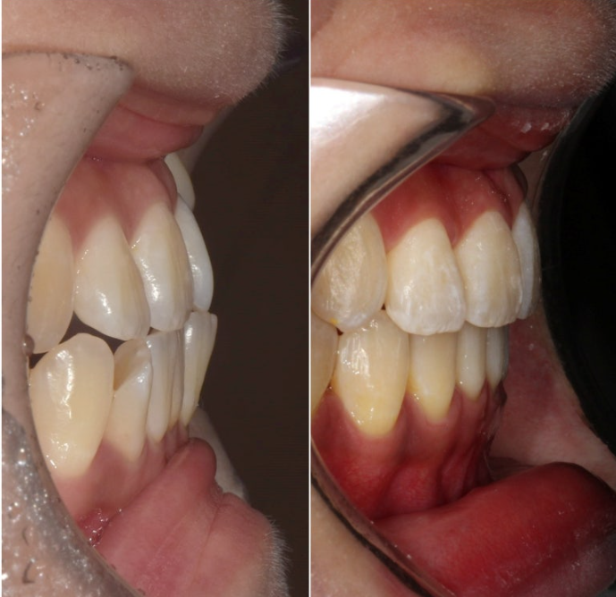 비발치 교정 덧니 인비절라인 교정 절단교합 반대교합 치료기간 1년 6개월 관련 이미지 25