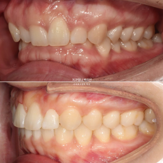 Inward-Tilted Teeth Orthodontic Treatment Review | Actual Case Improved with Non-Extraction Orthodontic Treatment for Gummy Smile, Deep Overbite & Gum Asymmetry — Gangnam Orthodontic Clinic image 16