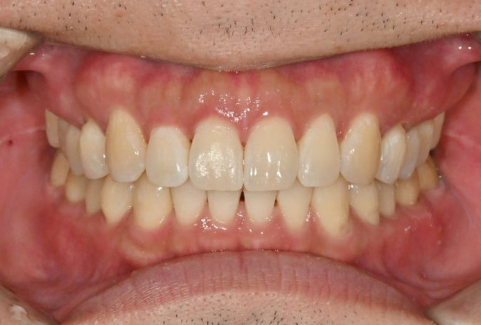 가위교합 벌어짐 중심선 과개교합 인비절라인 라이트 교정 관련 이미지 12