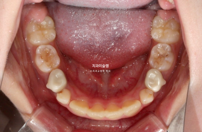 어린이 투명교정 인비절라인 퍼스트 과개교합 교정 후기 관련 이미지 11