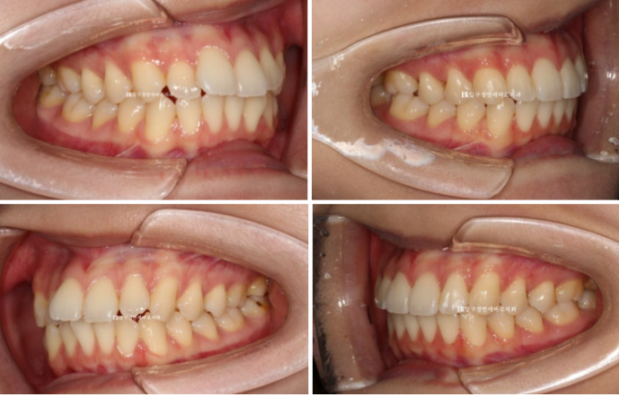Orthodontic Treatment for International Students: Is Short-Term Treatment Possible in Korea? | A Real 5-Month Front Teeth Partial Orthodontic Case image 7