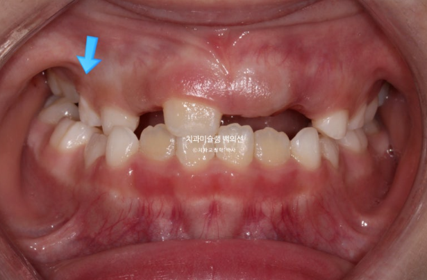 어린이 비대칭 반대교합 주걱턱 인비절라인 퍼스트 프리올소 성장 교정 관련 이미지 6