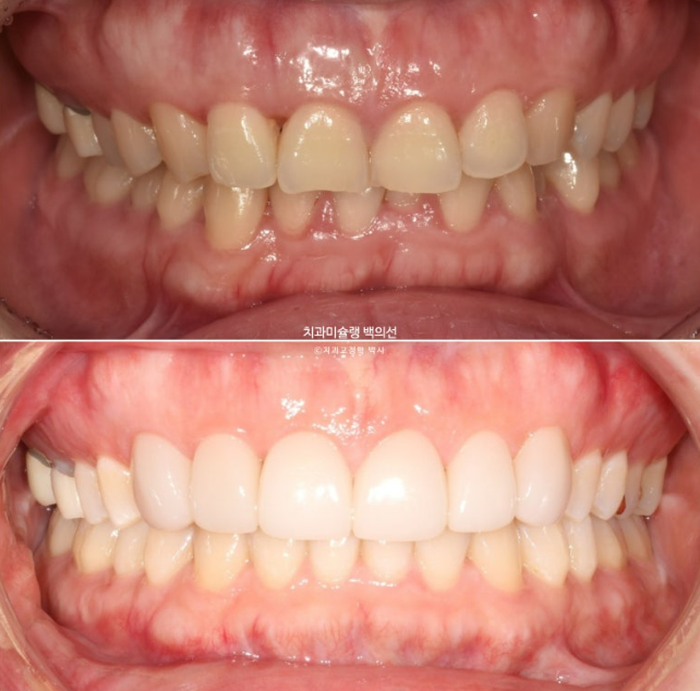 비발치 덧니 교정 인비절라인 과개교합 교정 무삭제 라미네이트 치료 후기 관련 이미지 20