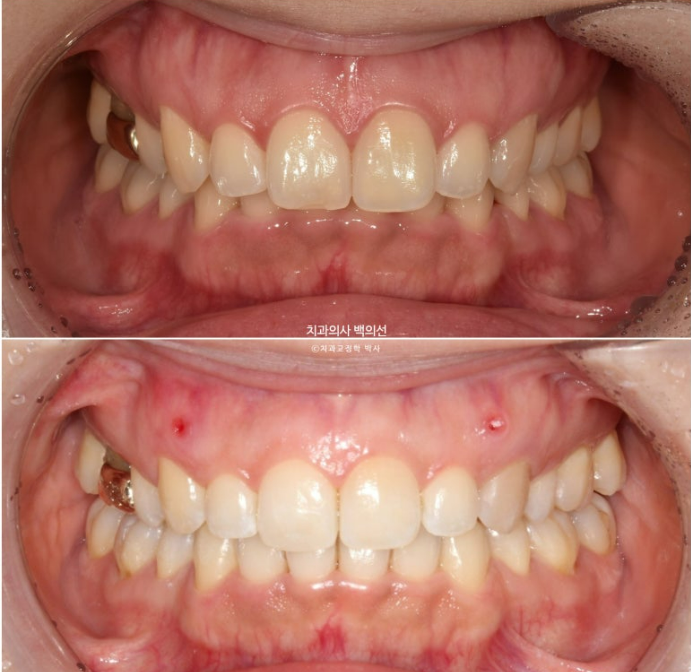 인비절라인 라이트 재교정 발치공간 벌어짐 ? 관련 이미지 9