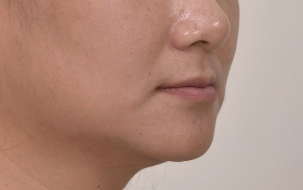 해외거주 앞니 선천적 결손 과개교합 인비절라인 라이트 브릿지 치료 관련 이미지 6